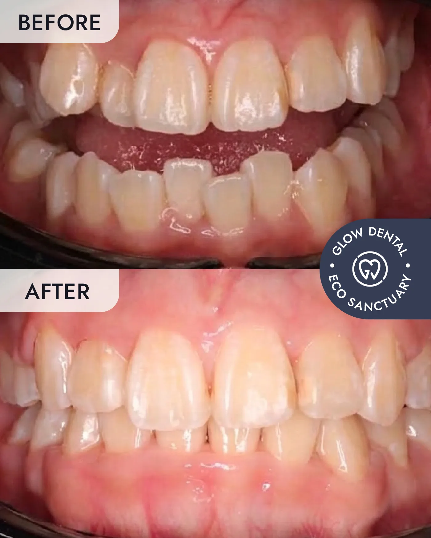 Braces before and after result, case 1, at Glow Dental