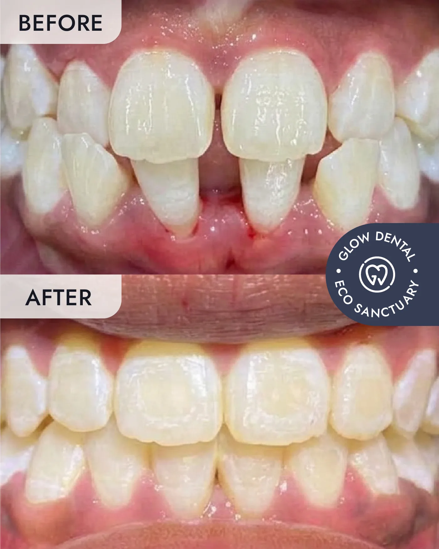 Braces before and after result, case 2, at Glow Dental