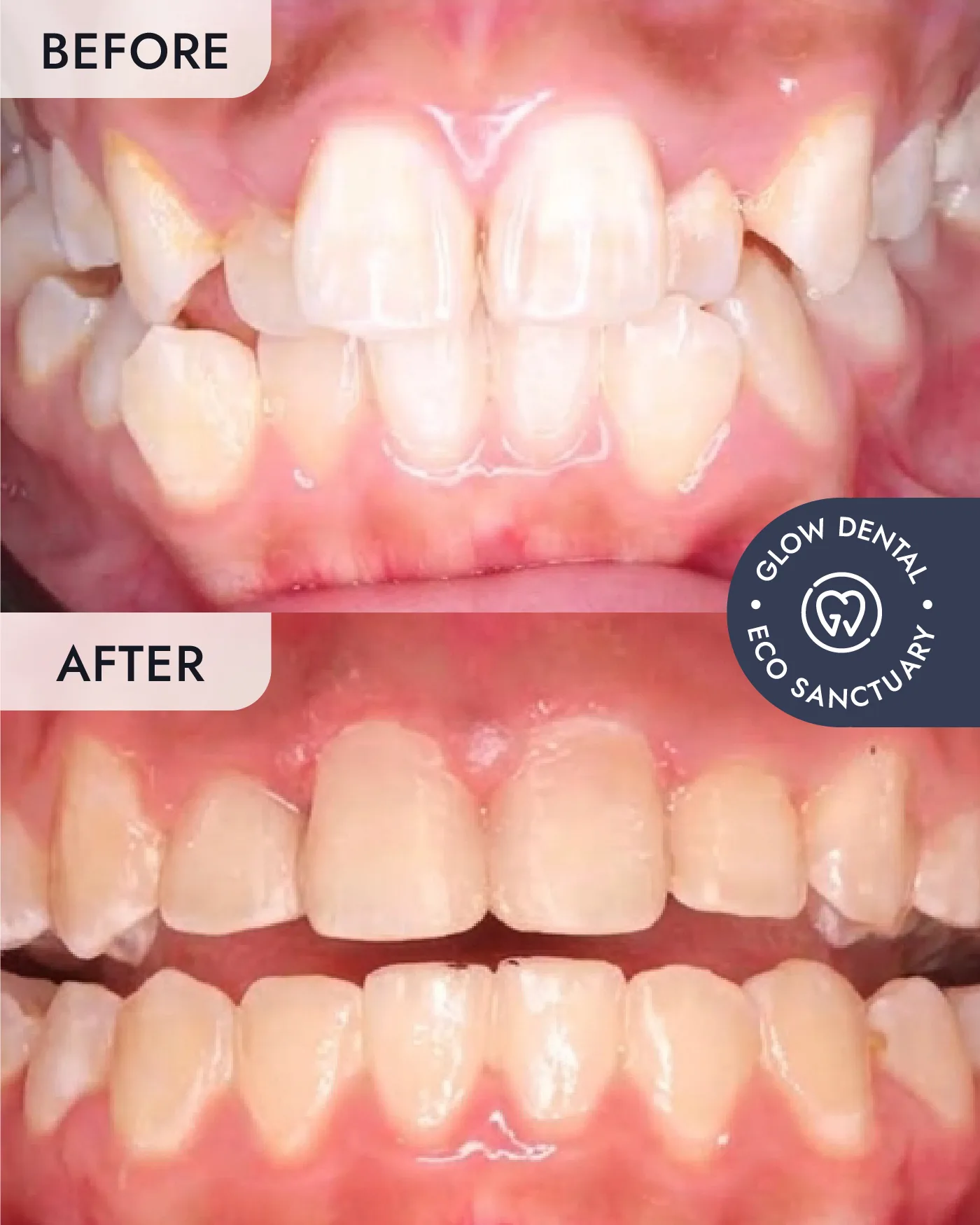 Braces before and after result, case 3, at Glow Dental