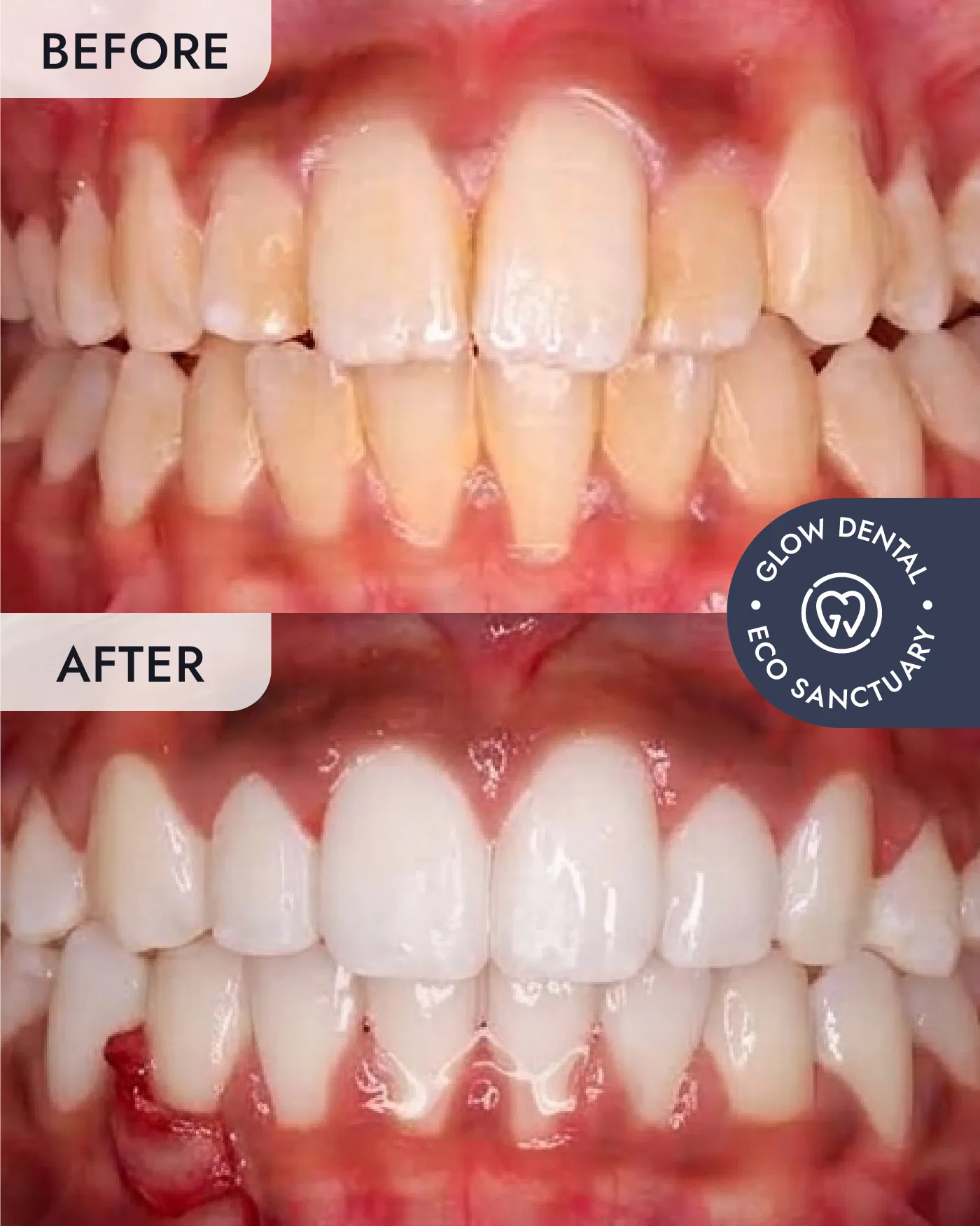 Braces before and after result, case 4, at Glow Dental