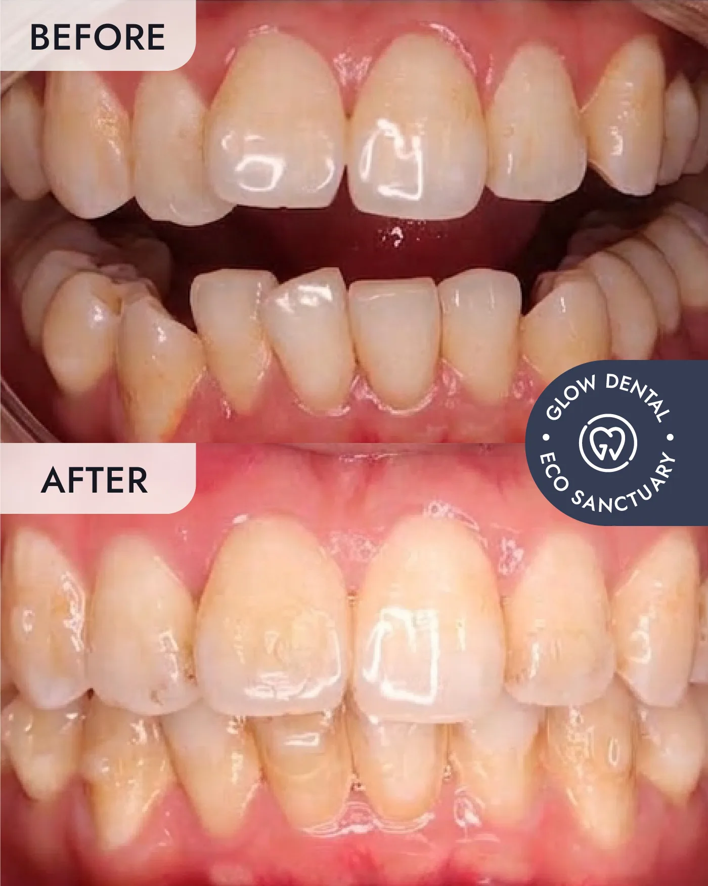 Clear Aligners before and after result, case 1, at Glow Dental