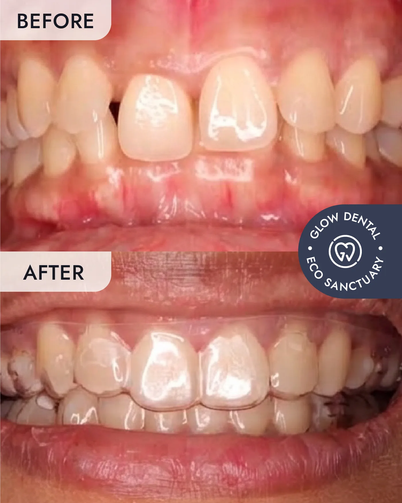 Clear Aligners before and after result, case 2, at Glow Dental