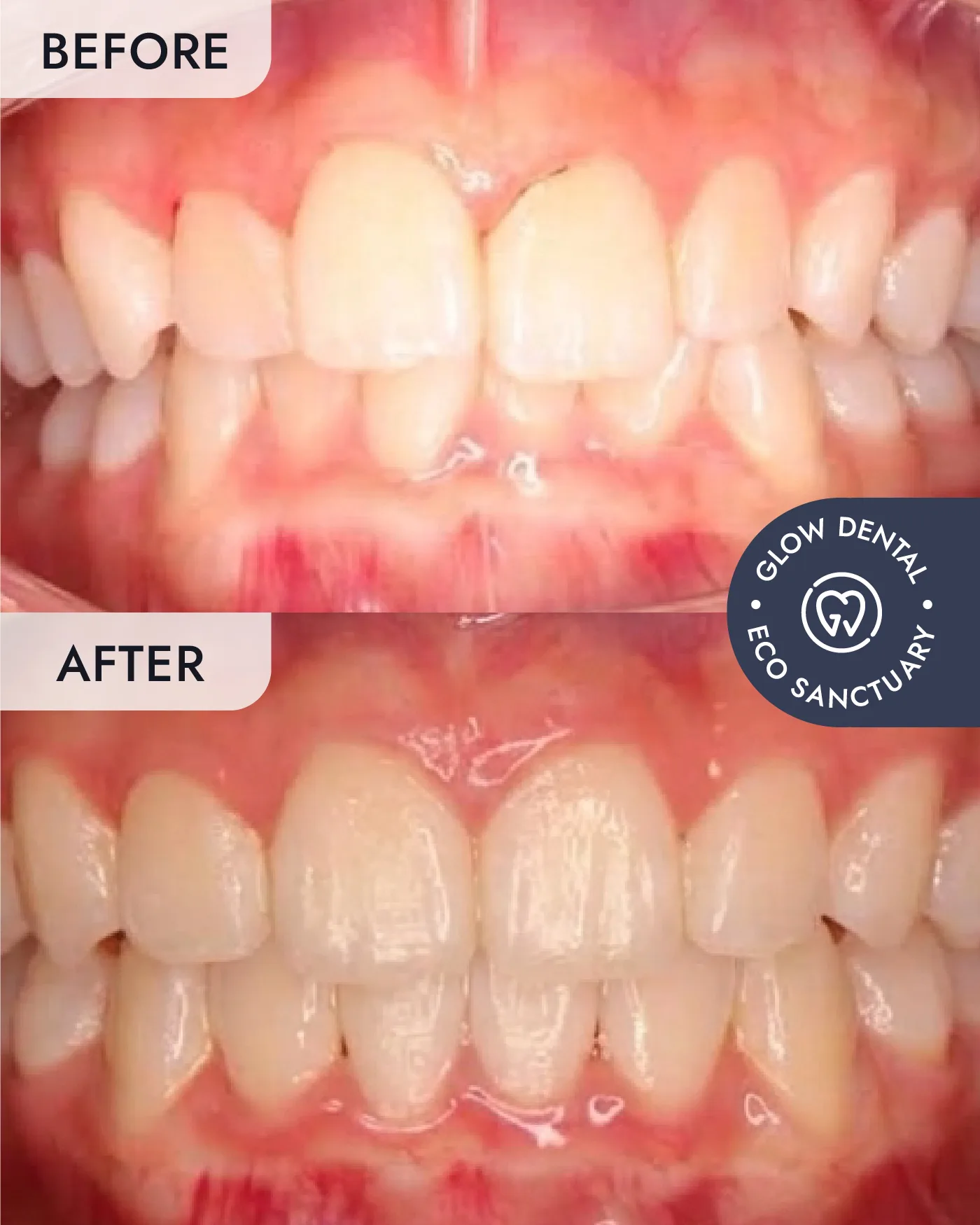 Clear Aligners before and after result, case 3, at Glow Dental
