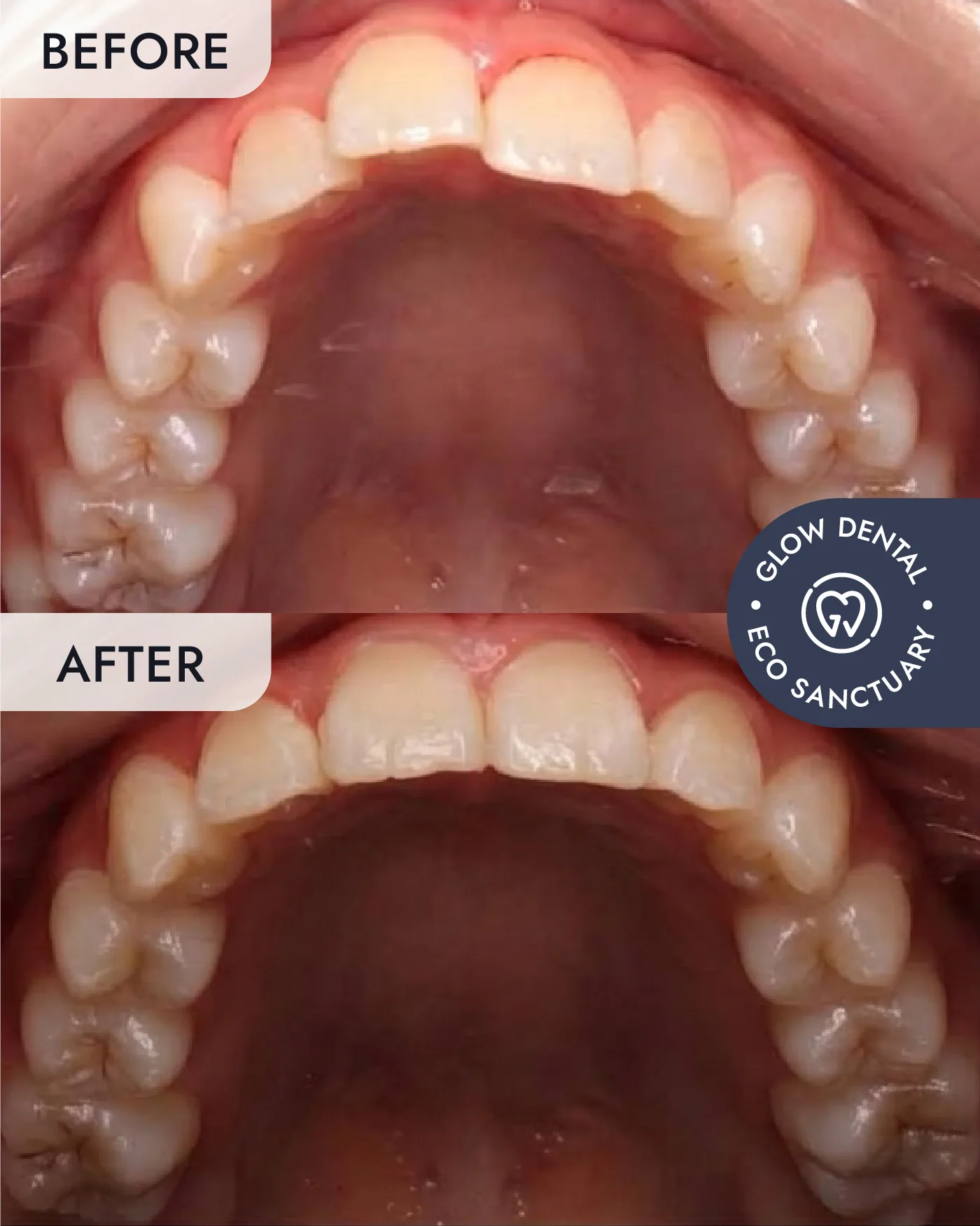 Clear Aligners before and after result, case 4, at Glow Dental
