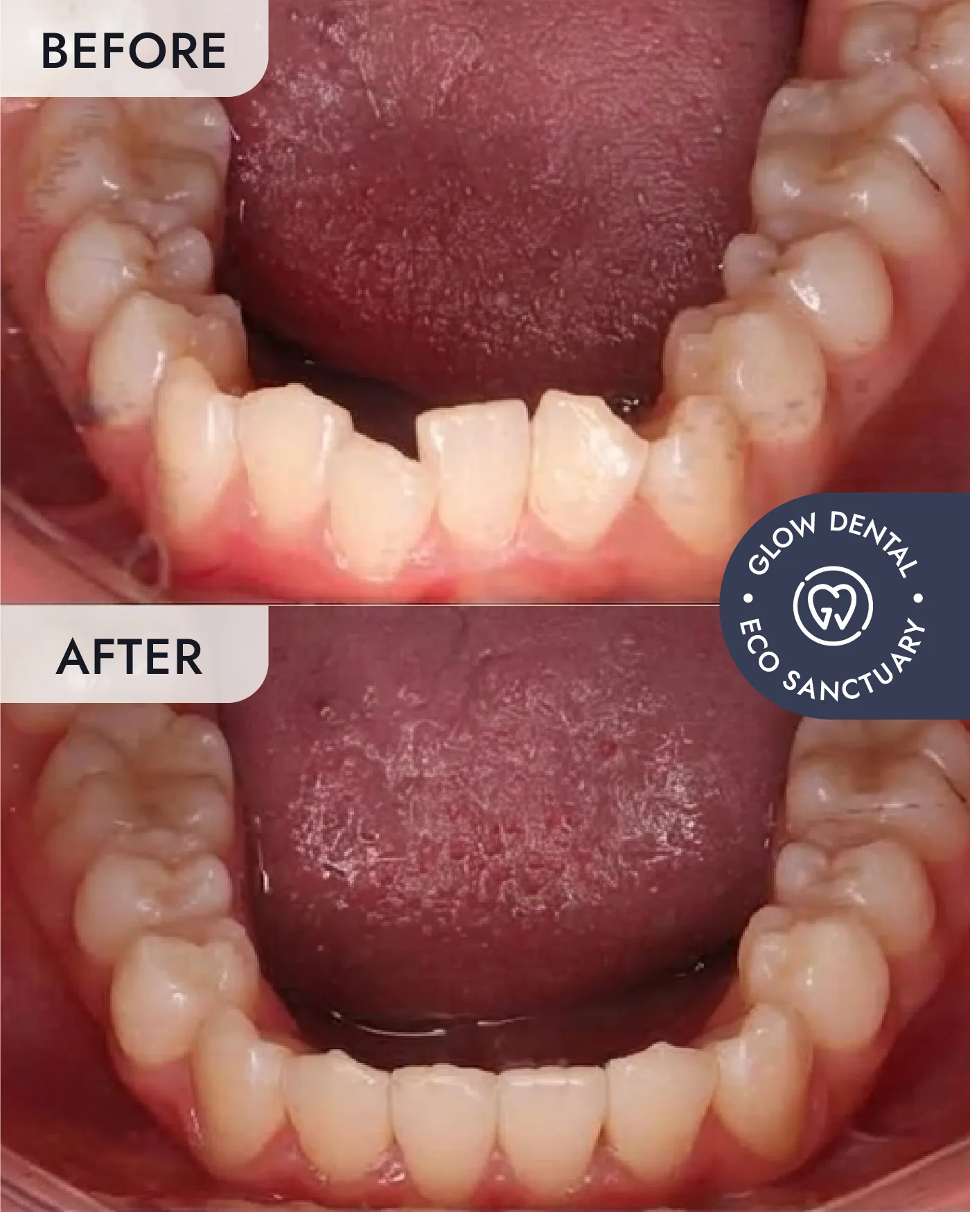 Clear Aligners before and after result, case 5, at Glow Dental