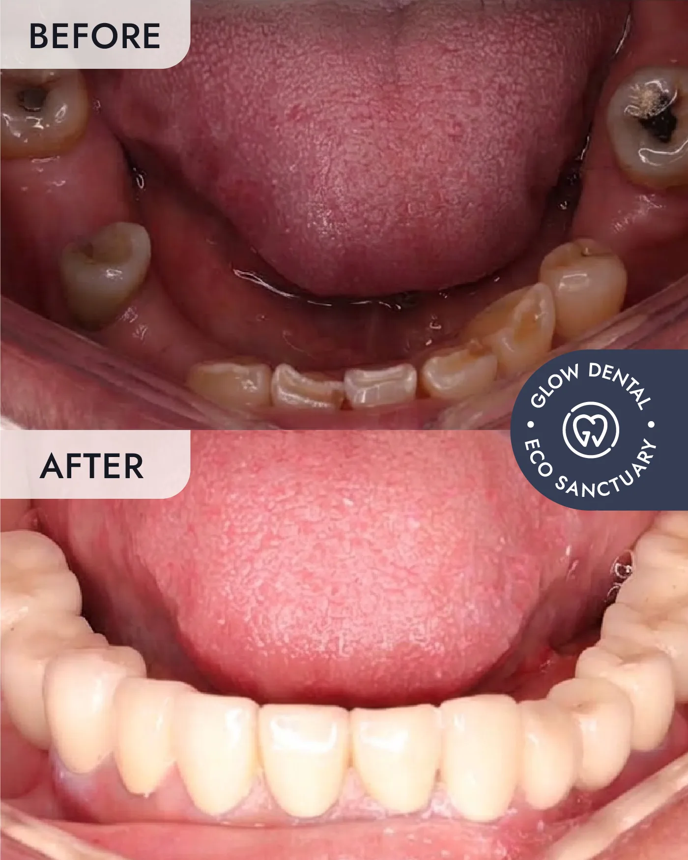 Crowns & Bridges before and after result, case 1, at Glow Dental