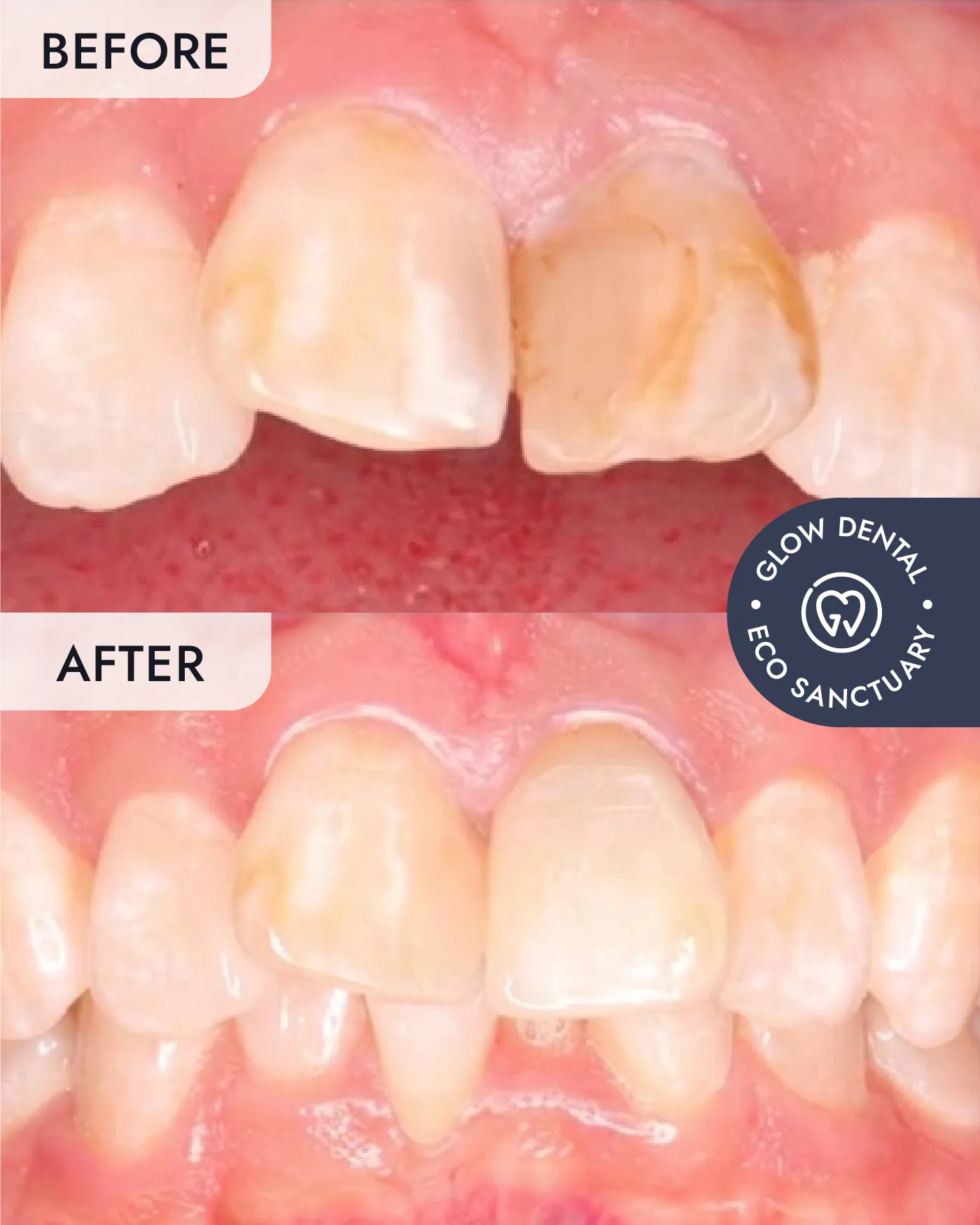 Crowns & Bridges before and after result, case 2, at Glow Dental