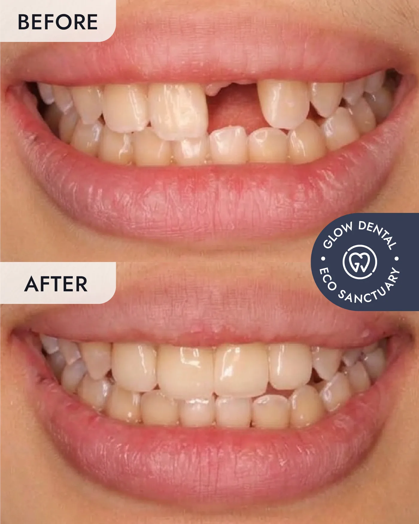 Crowns & Bridges before and after result, case 3, at Glow Dental