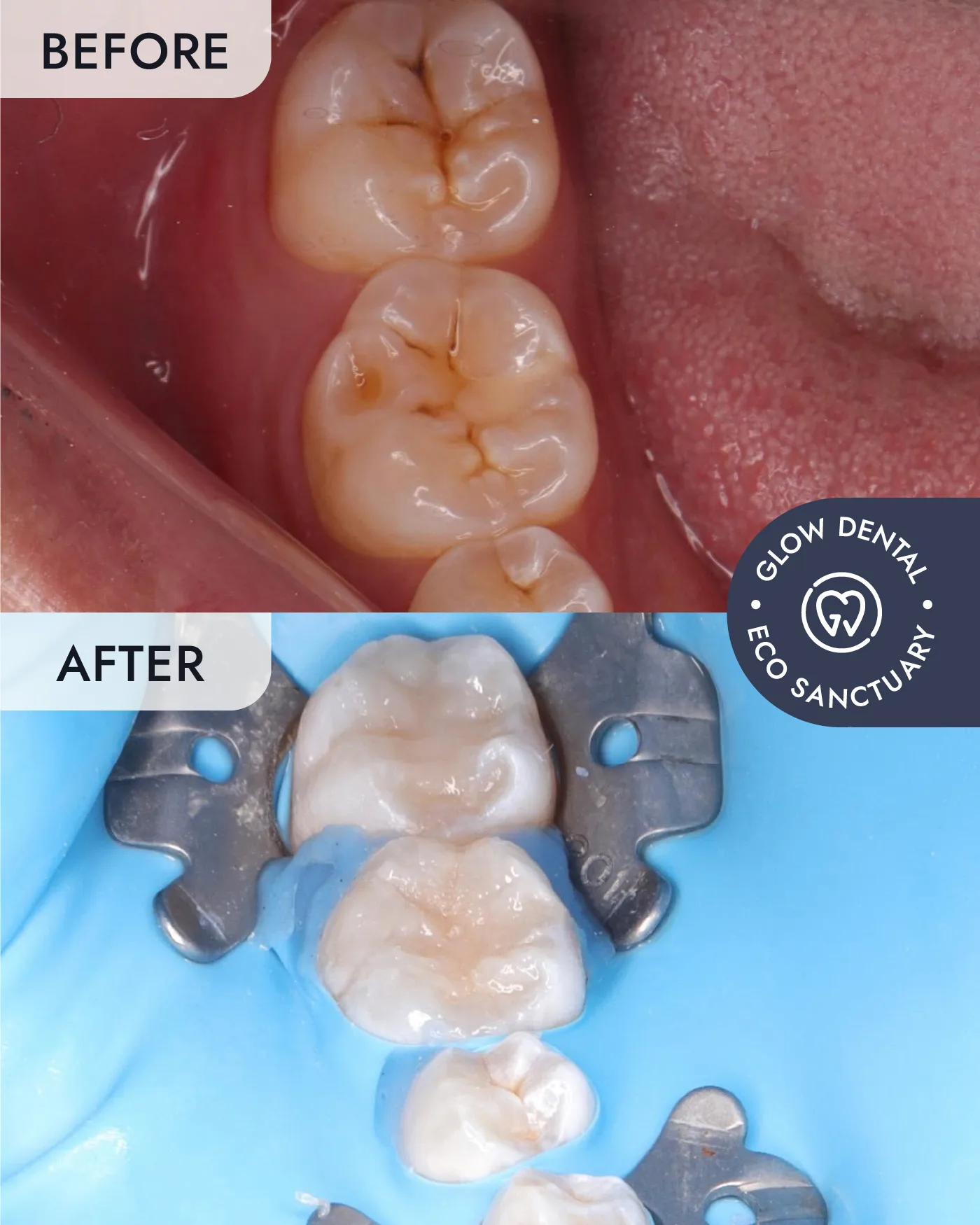 Dental Fillings before and after result, case 1, at Glow Dental