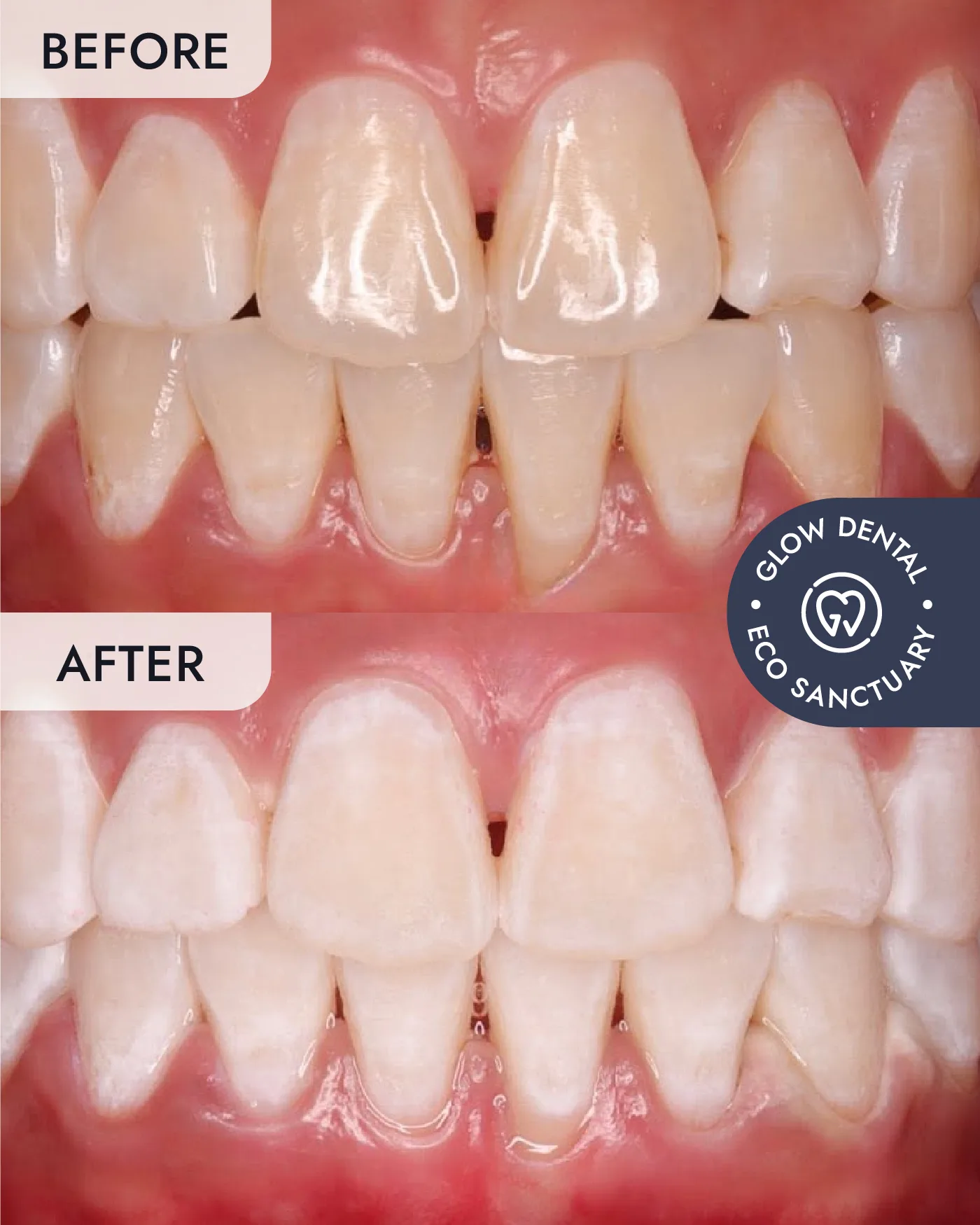 Teeth Whitening before and after result, case 1, at Glow Dental
