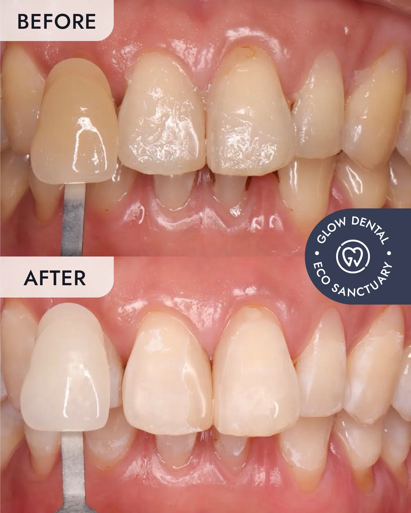 Teeth Whitening before and after result, case 2, at Glow Dental