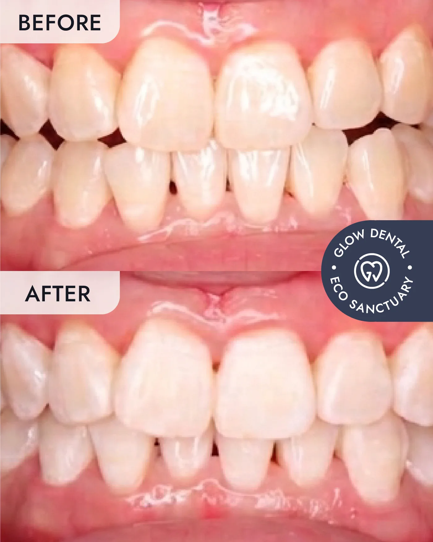 Teeth Whitening before and after result, case 3, at Glow Dental