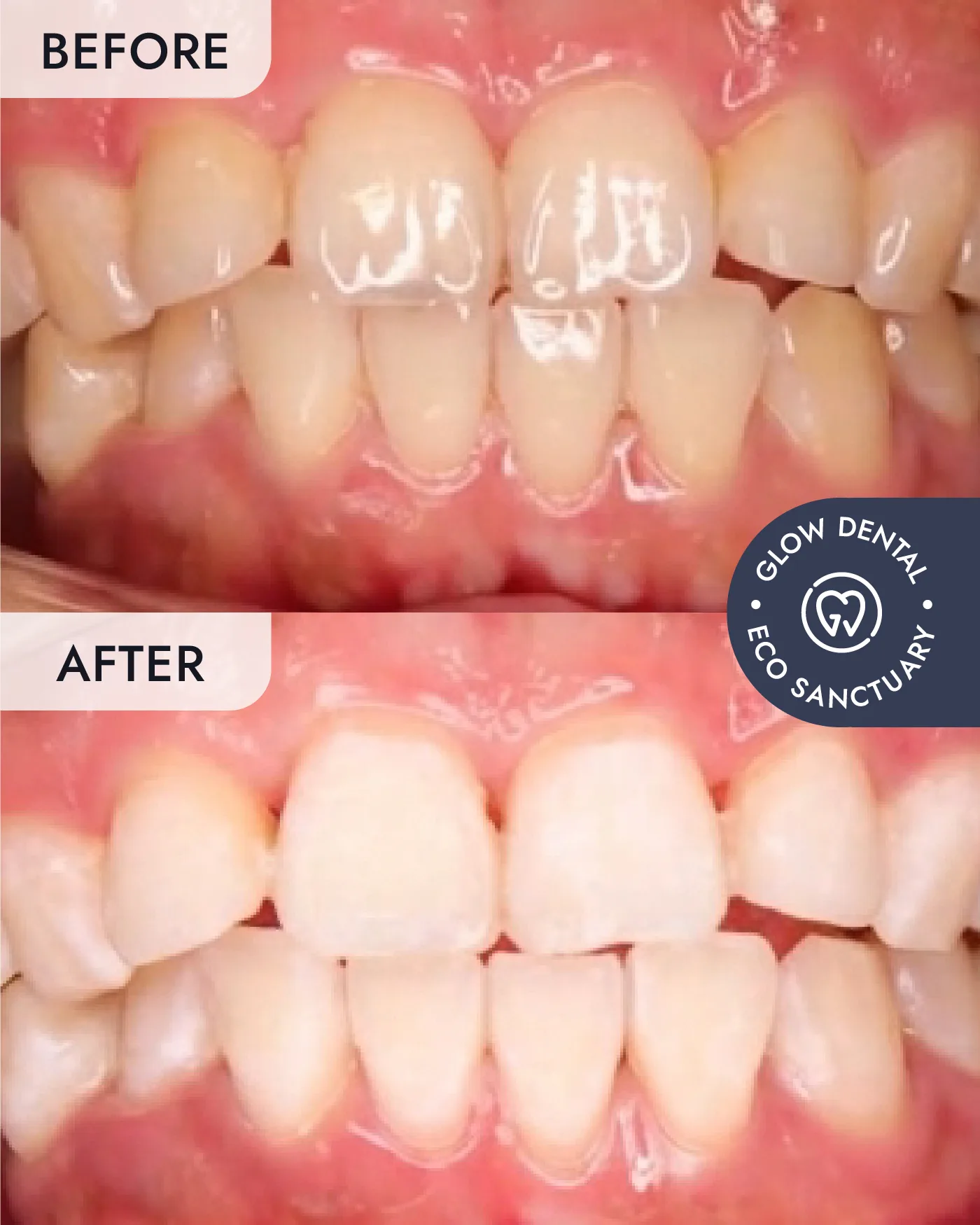 Teeth Whitening before and after result, case 4, at Glow Dental