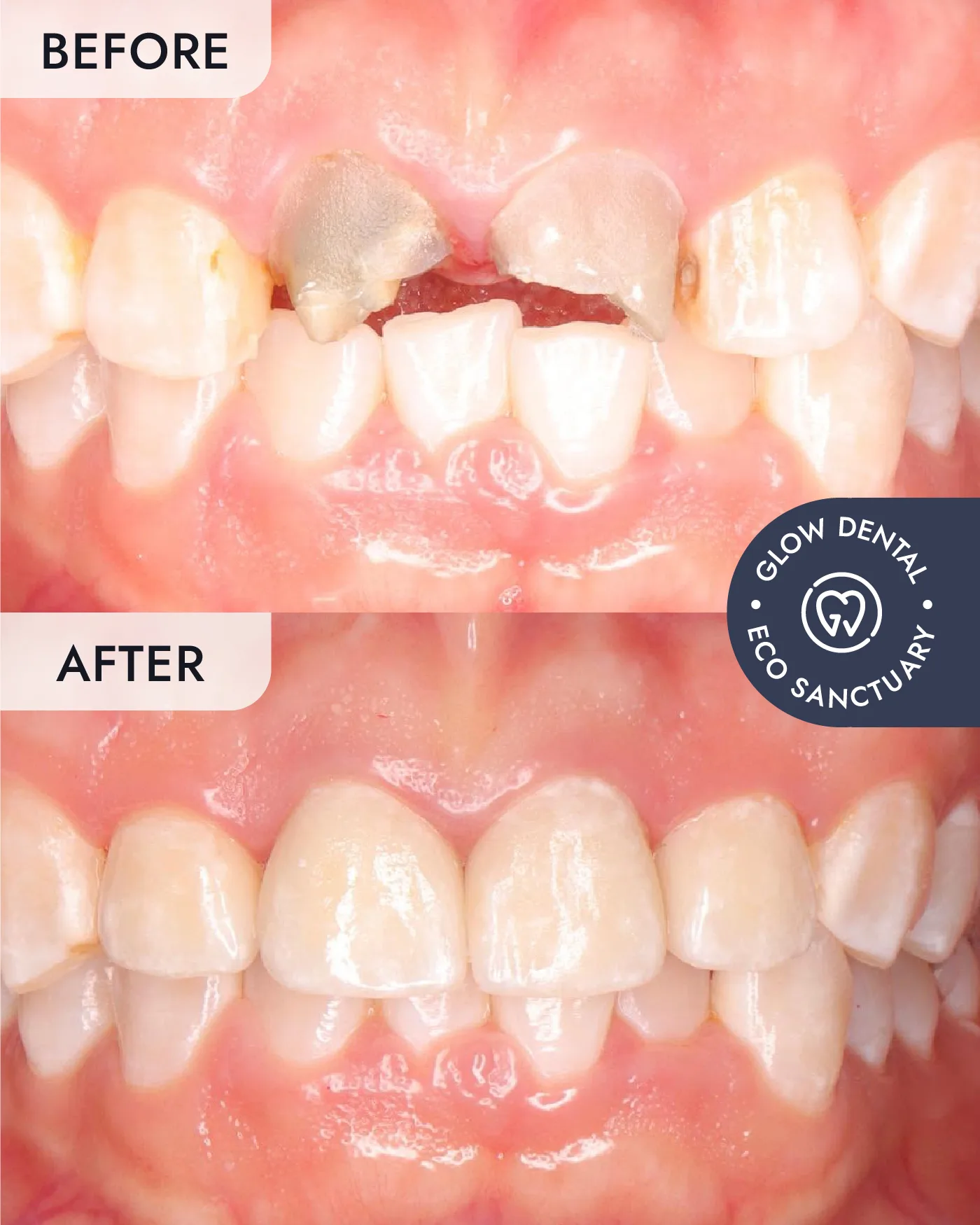Veneers before and after result, case 1, at Glow Dental