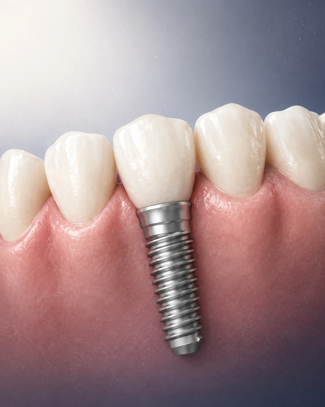 Dental implant results at Glow Dental