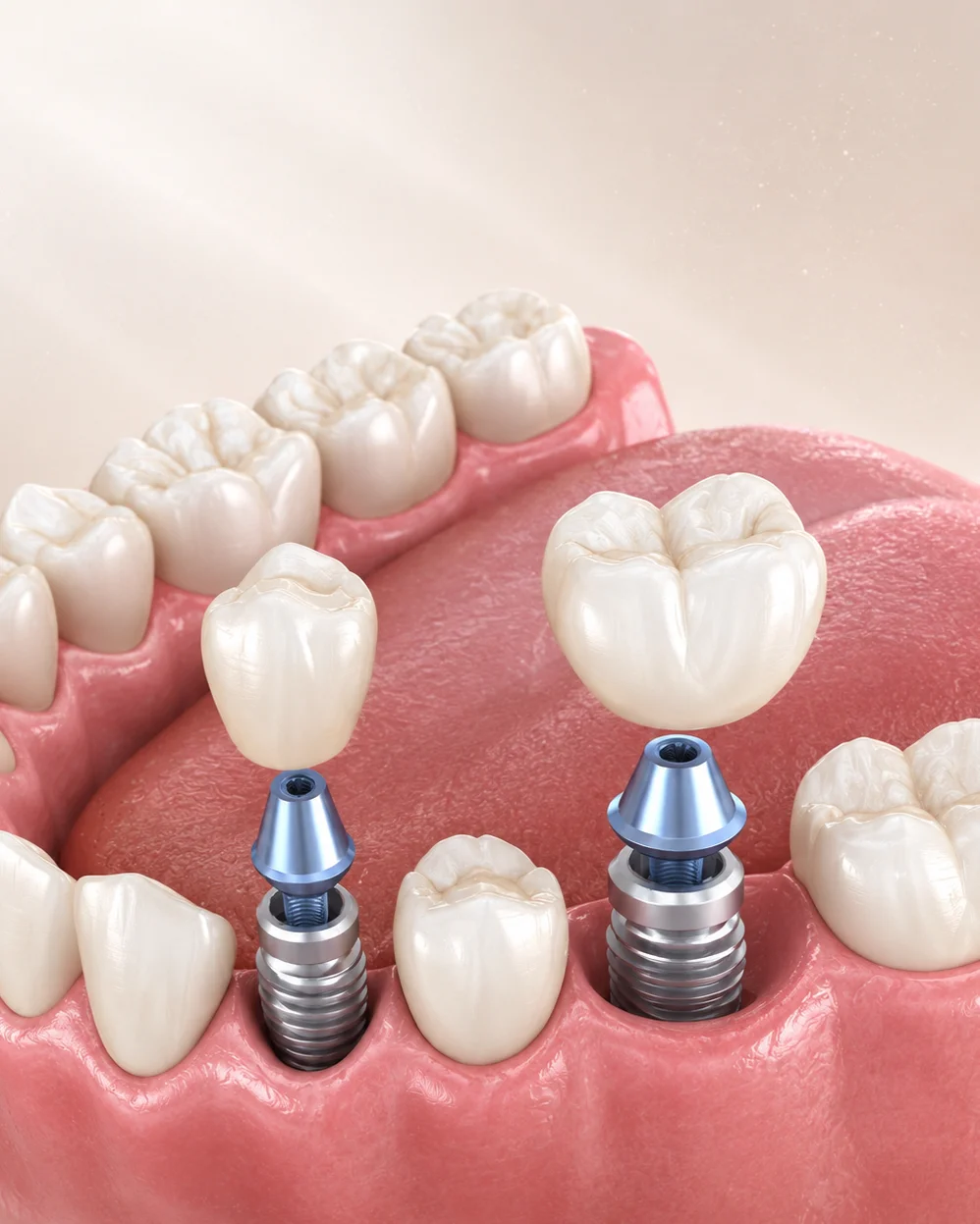 Dental implants explained at Glow Dental
