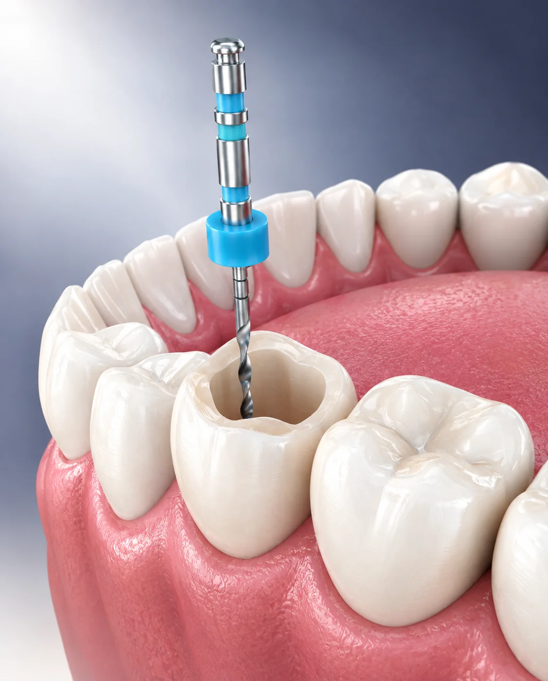 Root canal treatment results at Glow Dental