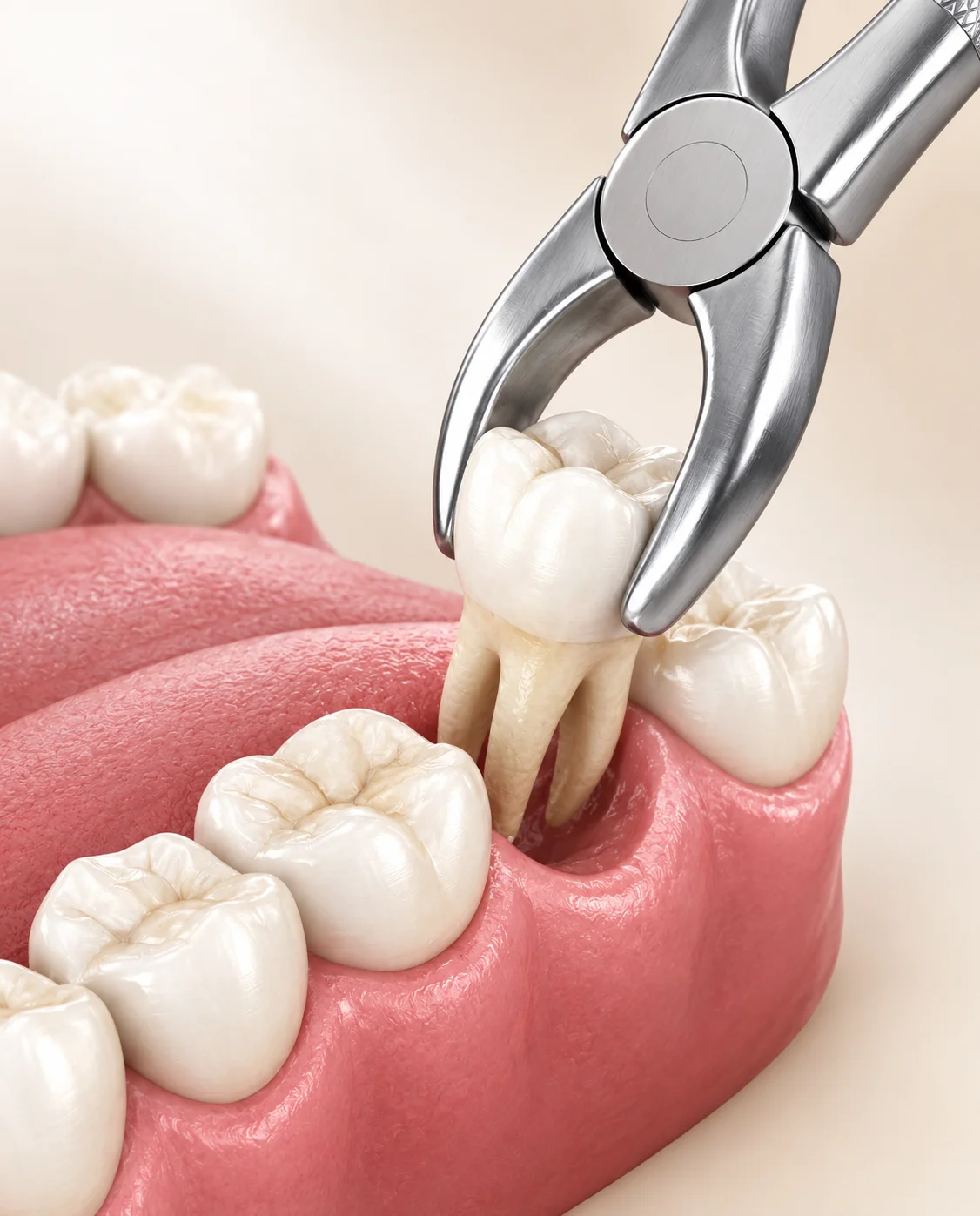 Tooth extraction results at Glow Dental